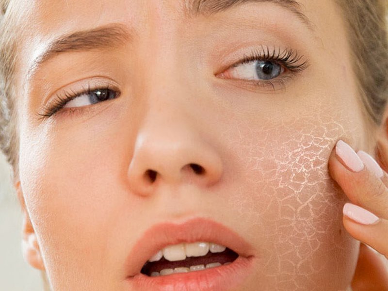 Слишком сухая кожа говорит о проблемах в организме? Отвечает дерматолог