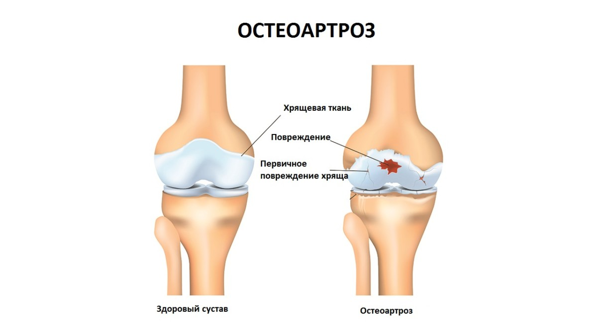 Деформирующий остеоартроз (доа). Первичный деформирующий остеоартроз. Заболевания коленного сустава остеоартроз. .Деформирующий остеоартрит остеоартроз.