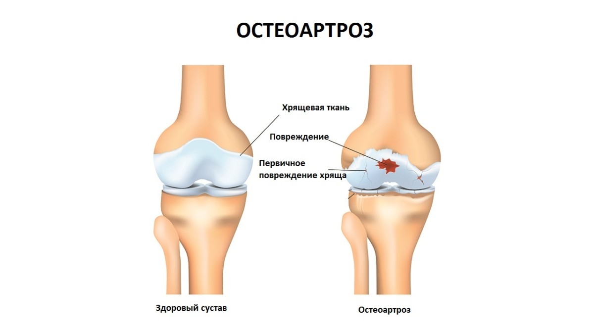 Какие заболевания сопутствуют остеоартроз, и чем чреваты последствия 