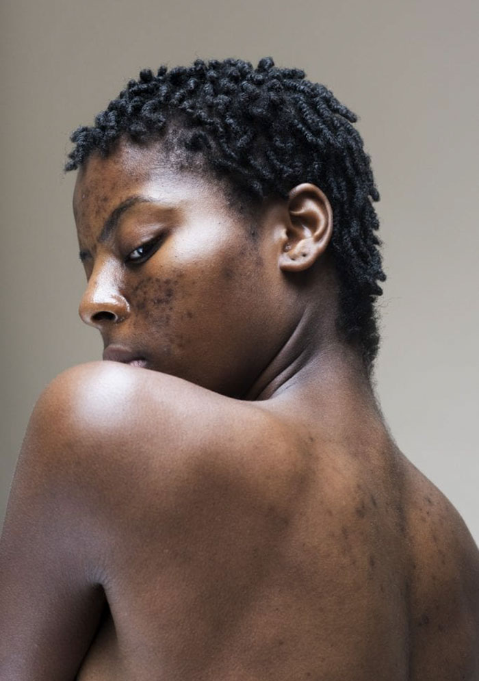 Серия портретов женщин с проблемной кожей и без макияж. ФОТО