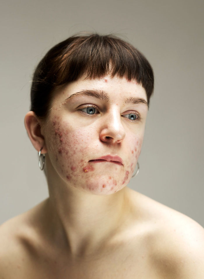 Серия портретов женщин с проблемной кожей и без макияж. ФОТО