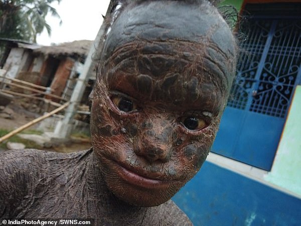 Человек-змея: из-за редкого заболевания кожа десятилетнего мальчика напоминает чешую. ВИДЕО