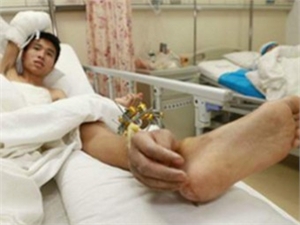 В Китае хирурги пришили мужчине кисть к ноге 