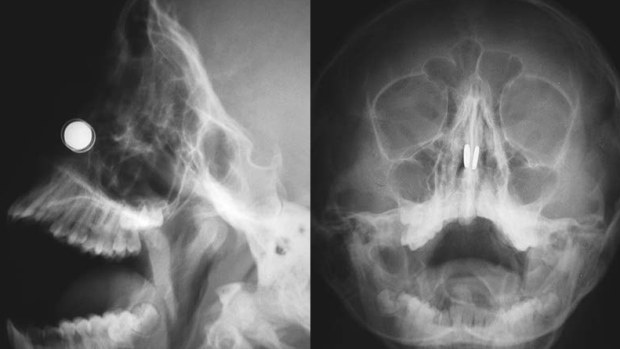 Австралийский ученый попал в больницу с магнитами в носу, пытаясь создать устройство от коронавируса. ФОТО