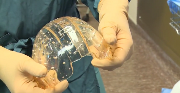 Впервые в истории медики пересадили череп, распечатанный на 3D-принтере 