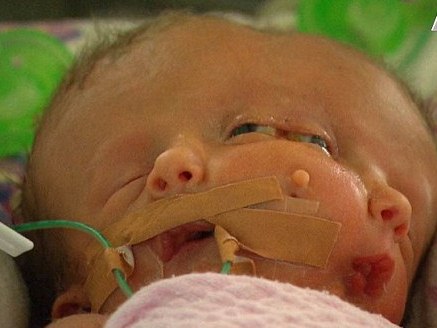 Австралийка родила девочку с двумя лицами и мозгами 