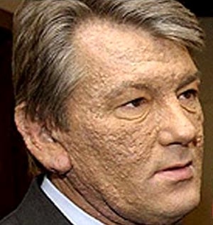 Виктор Ющенко рассказал об муках диоксинового отравления