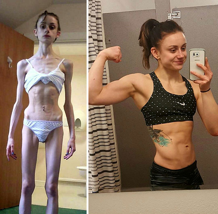 До и после: 20 примеров людей, сумевших побороть анорексию. ФОТО