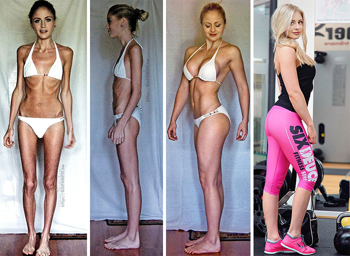 До и после: 20 примеров людей, сумевших побороть анорексию. ФОТО