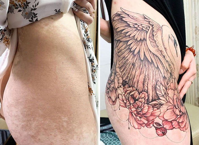 Как скрывающие шрамы татуировки помогают вернуть уверенность в себе. ФОТО
