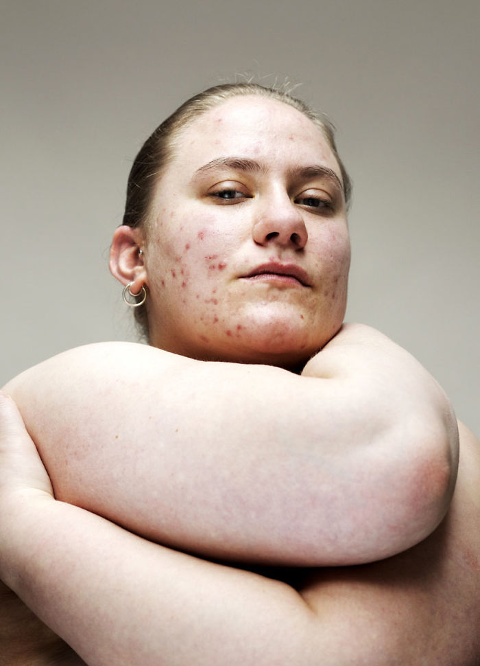 Серия портретов женщин с проблемной кожей и без макияжа. ФОТО