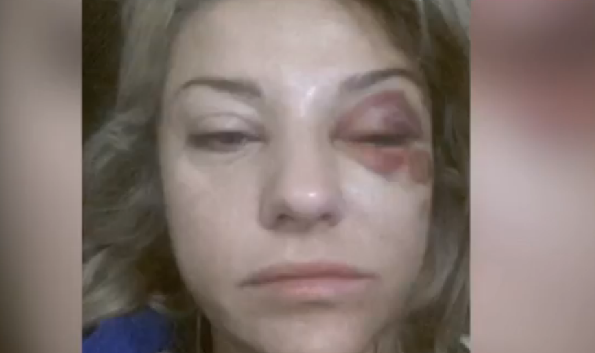 В интернете появилось фото избитой жены Марата Башарова