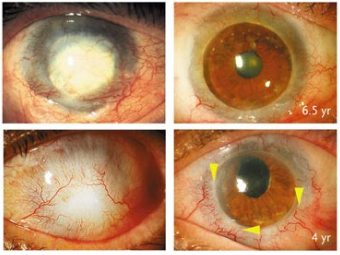 Глаза пациентов до (слева) и после лечения